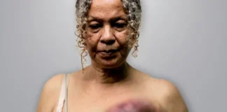 Crónica Uno: Cada día mueren 10 mujeres de cáncer de mama en Venezuela Crónica Uno: Cada día mueren 10 mujeres de cáncer de mama en Venezuela