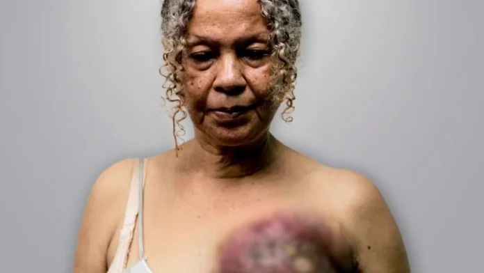 Crónica Uno: Cada día mueren 10 mujeres de cáncer de mama en Venezuela Crónica Uno: Cada día mueren 10 mujeres de cáncer de mama en Venezuela