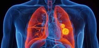 5.8 mil nuevos casos de cáncer de pulmón se diagnosticarían este año en Venezuela 5.8 mil nuevos casos de cáncer de pulmón se diagnosticarían este año en Venezuela