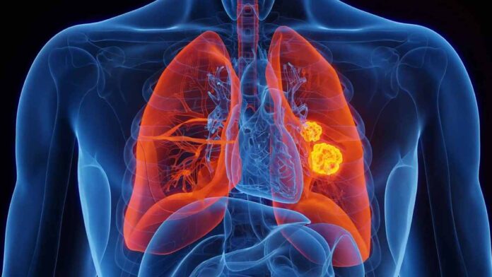 5.8 mil nuevos casos de cáncer de pulmón se diagnosticarían este año en Venezuela 5.8 mil nuevos casos de cáncer de pulmón se diagnosticarían este año en Venezuela