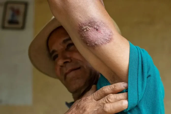 Confirman más de 100 casos de leishmaniasis en Monagas Confirman más de 100 casos de leishmaniasis en Monagas